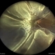 Retinal Detachment Retinal Detachment
