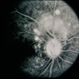 Scleritis / OIS Scleritis / OIS