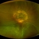 Morning glory optic disc anomaly with retinal detachment Morning glory optic disc anomaly with retinal detachment