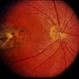 Toxoplasmosis / Macular Scar / Active Toxoplasmosis / Macular Scar / Active