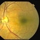 Polypoidal Choroidal Vasculopathy