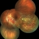 CMV Retinitis/ Before Treatment CMV Retinitis/ Before Treatment