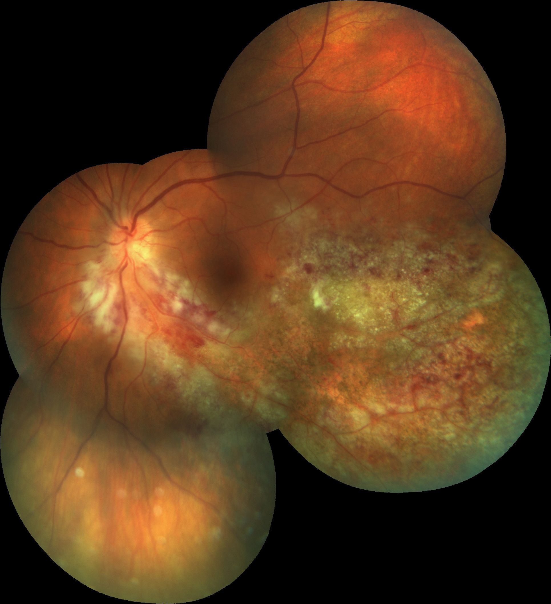 retinitis definition retinitis definition