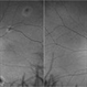 Fundus Autofluorescence in Central Areolar Choroidal Dystrophy Fundus Autofluorescence in Central Areolar Choroidal Dystrophy