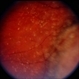 Choroidal Melanoma With Vitreous Seeding Choroidal Melanoma With Vitreous Seeding