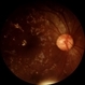 Diabetic Retinopathy Diabetic Retinopathy