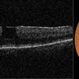Macular Pseudohole