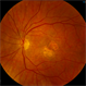 Neovascular AMD