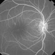 Tamoxifen Retinopathy  with Pseudocystic Foveal Cavitation - FA Recirculation