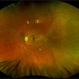 Macula Off Retinal Detachment with CNV Macula Off Retinal Detachment with CNV