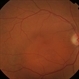 Choroidal Hemangioma Discrete Photo Choroidal Hemangioma Discrete Photo
