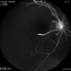 Central Retinal Artery Occlusion Central Retinal Artery Occlusion