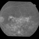Adult Coats' Disease
