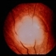 Tuberous Sclerosis Tuberous Sclerosis