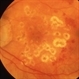 Late Atrophy of ALPC Spots Late Atrophy of ALPC Spots