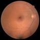 Small subILM Hemorrhage