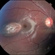 Torpedo Maculopathy Torpedo Maculopathy