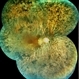 Retinitis Pigmentosa Retinitis Pigmentosa