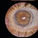 Iris Bombe