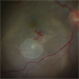 Subretinal Cysticercus Cyst -Intraoperative Picture Subretinal Cysticercus Cyst -Intraoperative Picture