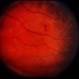 Retinal Capillary Hemangioblastoma Retinal Capillary Hemangioblastoma