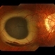 Submacular Hemorrhage Submacular Hemorrhage