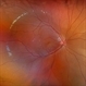 Sturge-Weber Syndrome Sturge-Weber Syndrome