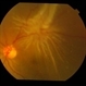 Retinal Fold Near Retinal Break in Rhegmatogenous Retinal Detachment