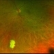 Posterior Ophthalmomyiasis Interna Posterior Ophthalmomyiasis Interna
