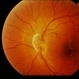 Vitreous Traction on Disc / PVD Vitreous Traction on Disc / PVD