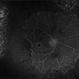 Multiple Myeloma with Cytomegalovirus Retinitis Multiple Myeloma with Cytomegalovirus Retinitis