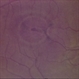 Butterfly Shaped Pigment Dystrophy Butterfly Shaped Pigment Dystrophy
