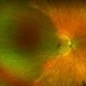 Isolated Choroidal Melanocytosis Isolated Choroidal Melanocytosis