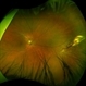 Posterior Scleral Laceration