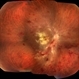 Acute Necrotizing Retinal Vasculitis as Onset of Systemic Lupus Erythematosus. Acute Necrotizing Retinal Vasculitis as Onset of Systemic Lupus Erythematosus.