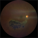 Sectoral Retinitis Pigmentosa Sectoral Retinitis Pigmentosa