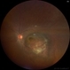 Choroidal Hemangioma Choroidal Hemangioma