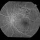 BRVO With Non-Perfusion