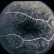 Adult Foveomacular Dystrophy / Pattern Adult Foveomacular Dystrophy / Pattern