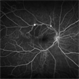 Neovascularization in a combined CRAO/BRVO Neovascularization in a combined CRAO/BRVO