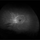 Proliferative Diabetic Retinopathy and SC Disease Proliferative Diabetic Retinopathy and SC Disease