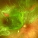 Rhegmatogenous Retinal Detachment Rhegmatogenous Retinal Detachment