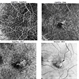 Macular Telangiectasia Type 2 OCTA Macular Telangiectasia Type 2 OCTA