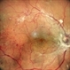 Proliferative Diabetic Retinopathy Proliferative Diabetic Retinopathy