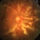 Lipemic Retina Lipemic Retina