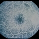 Ring 17 Chromosome Ring 17 Chromosome