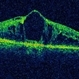 Radiation Maculopathy