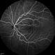 Macular Pucker
