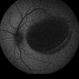 Primary Subhyaloid Hemorrhage Due to Valsalva Retinopathy