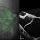 Myopic Traction Maculopathy